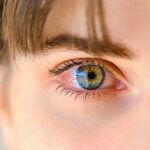 Síndrome del Ojo Seco y Acupuntura